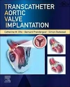 Transcatheter Aortic Valve Implantation | کاشت دریچه آئورت ترانس کاتتر